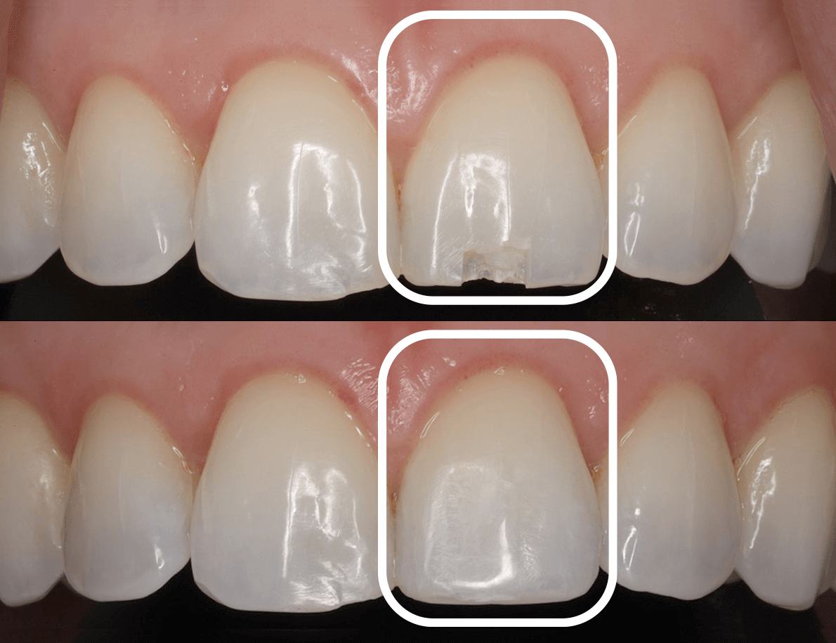 Before & After, Cracked Tooth Repair Images