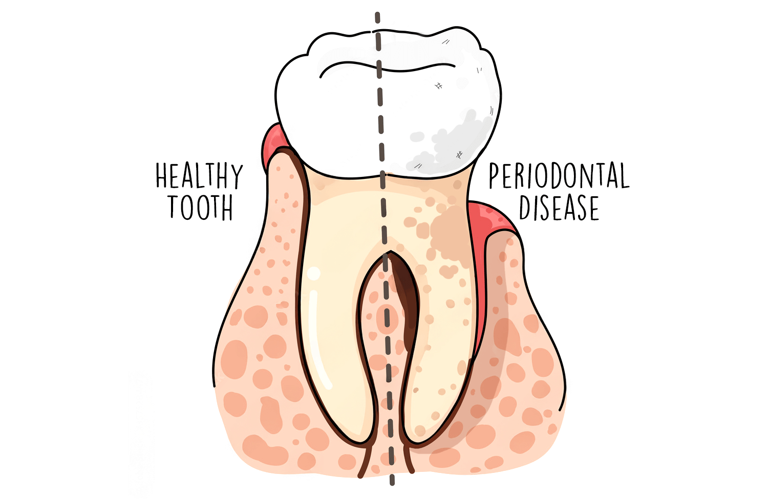 Understanding and Managing Periodontal Disease