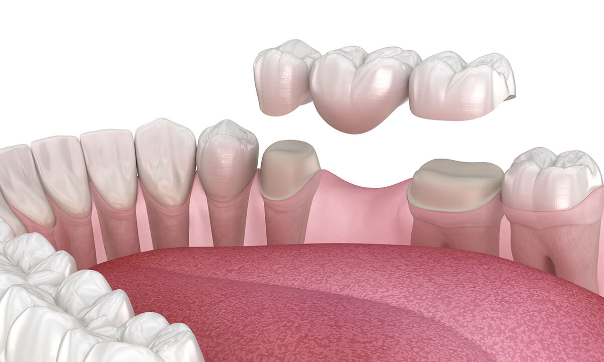 Dental Bridges - An affordable tooth replacement option