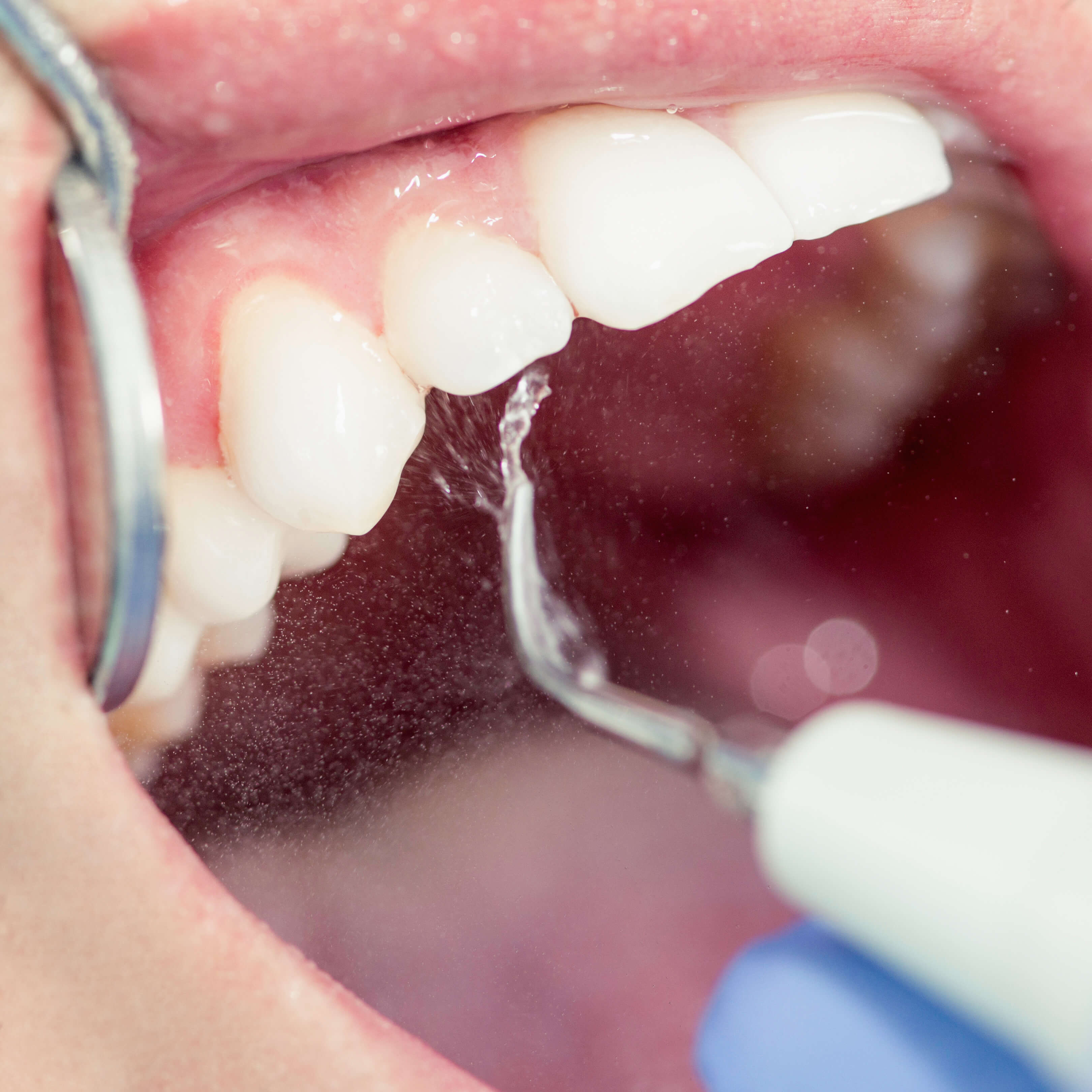 Taking Care of Your Gums